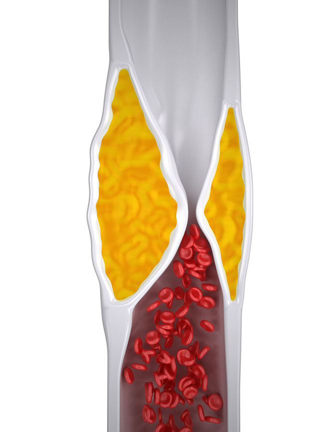 Przyjaciel czy wróg: czy cholesterol jest zły i czy powinniśmy się go pozbyć?